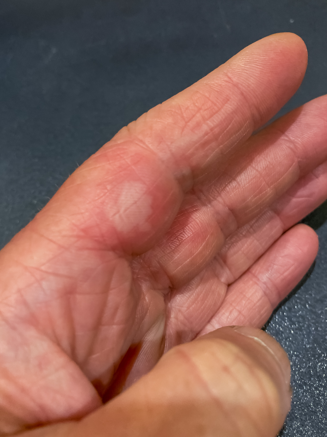 A photo of a left hand with a large burn blister underneath the pointer finger